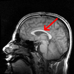 Mri_brain_side_view-emphasizing-corpus-callosum